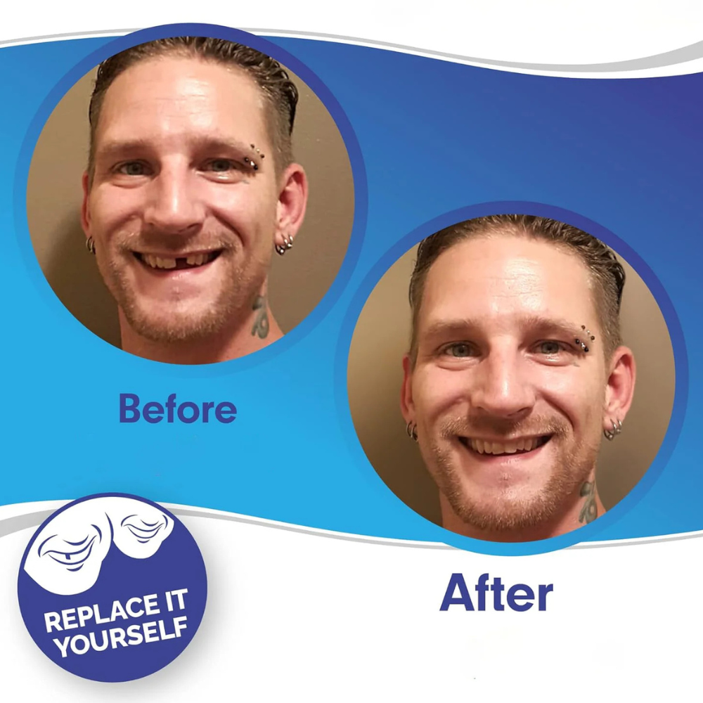 Coques dentaires amovibles